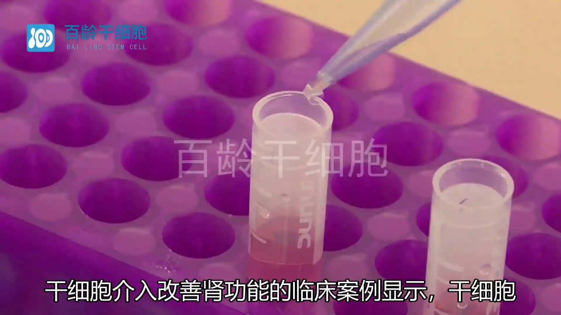 干细胞介入改善肾功能的临床案例