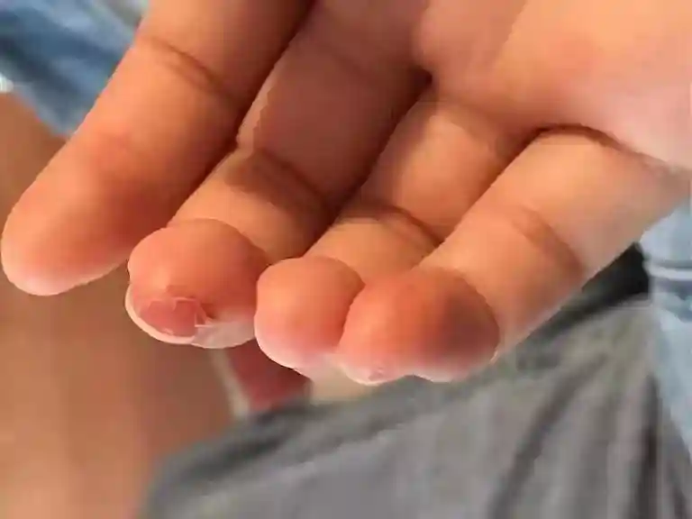 高发皮肤病，冬季防治正当时！用对方法，告别瘙痒、水疱、脱屑