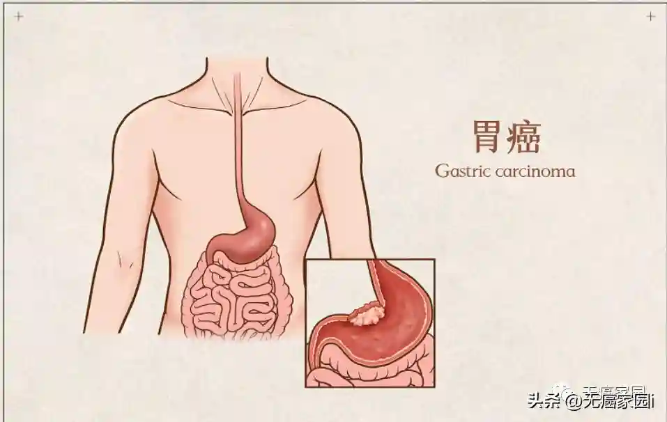 无癌生存近4年！NK疗法不容小觑，晚期胃癌患者输注至今无复发