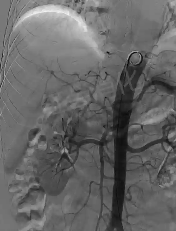 西安市红会医院 让肿瘤“饿”死的TACE术 为两例中晚期肝癌排忧